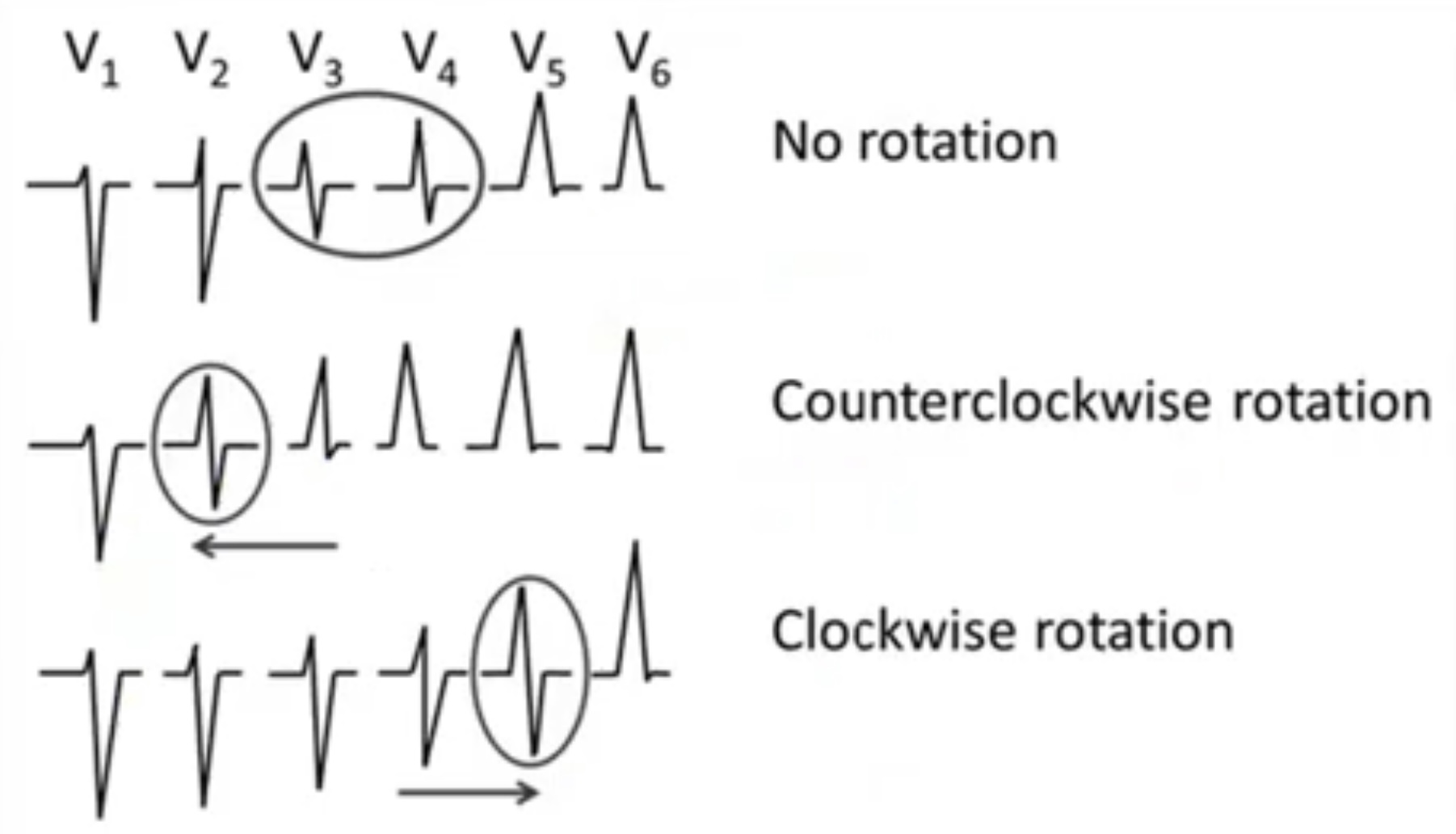 Սրտամկանի հիպերտրոֆիաներ