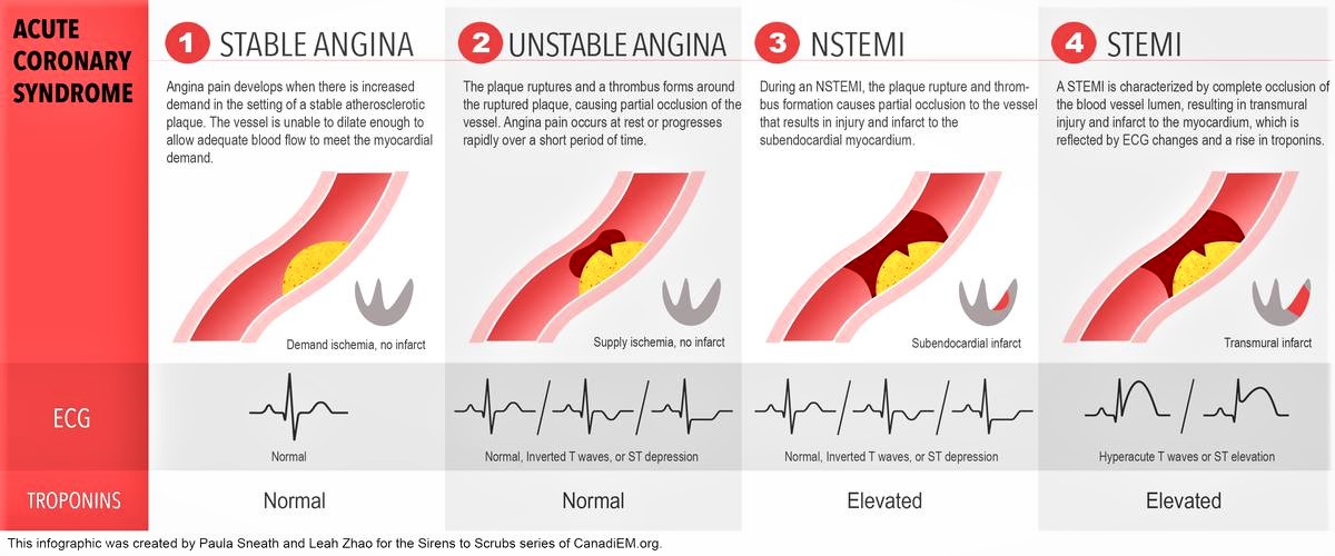 Սուր կորոնար համախտանիշ